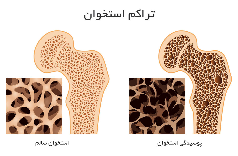 تراکم استخوان