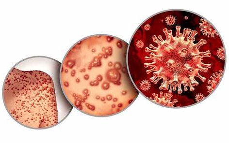 آبله میمونی